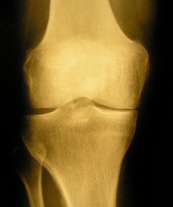 arthrose-behandlung-ohne-operation