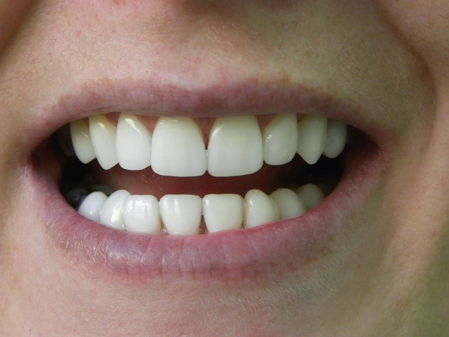 Der beste Schutz vor Gingivitis: Professionelle Zahnreinigung