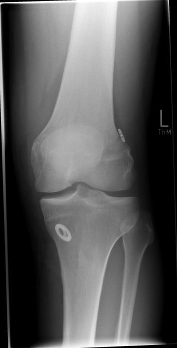 riss-des-vorderen-kreuzbandes-ursachen-behandlung