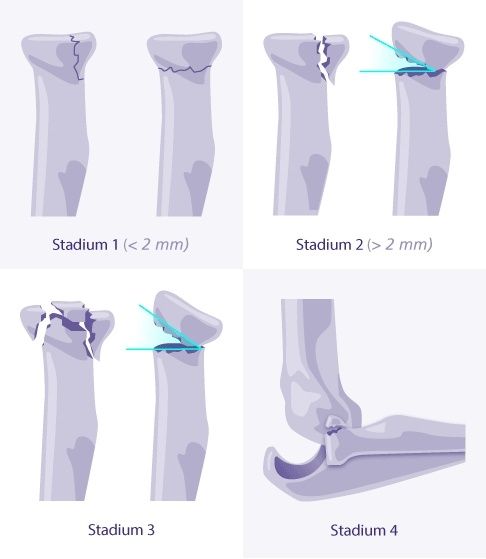 radiuskoepfchenfraktur-symptome-diagnose-und-behandlung