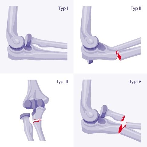 monteggia-fraktur-ursachen-diagnose-und-behandlung