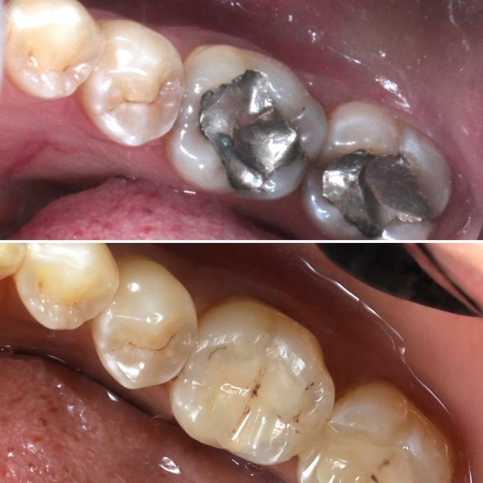 Die verschiedenen Füllungsmaterialien: Amalgam und Composite im Vergleich