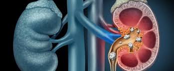 Böbrek Sağlığını Korumak İçin Risk Grubunda Olanlar Neler Yapmalı?