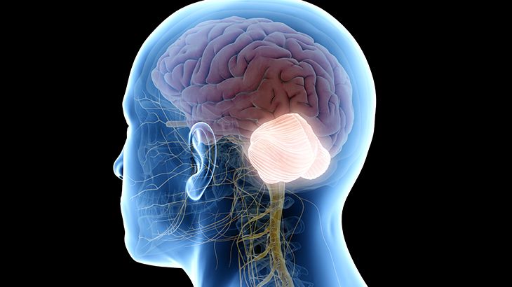 Chiari Malformasyonu ( Beyincik Sarkması )