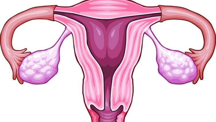 Çikolata Kisti Nedir?