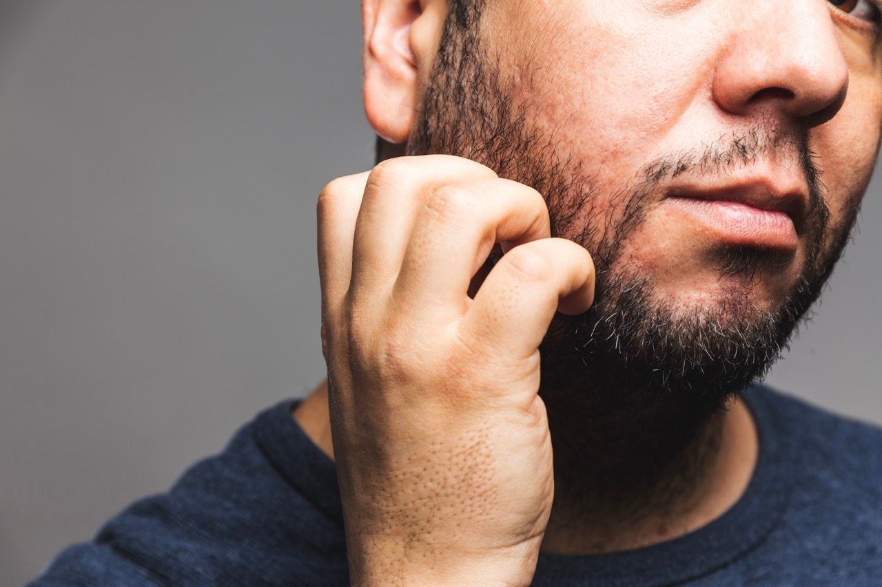 Tiña de la barba: causas, síntomas y tratamiento
