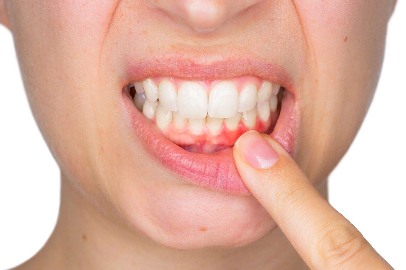 Diş Eti Çekilmesi (Periodontitis) Nedir? Nasıl Tedavi Edilir?