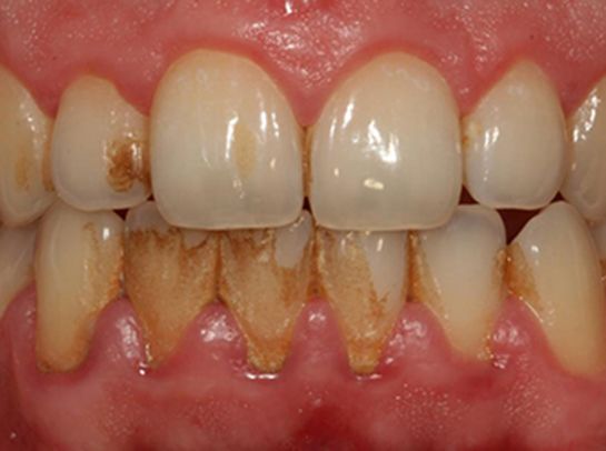 DİŞ TARTARI HAKKINDA SORU CEVAP