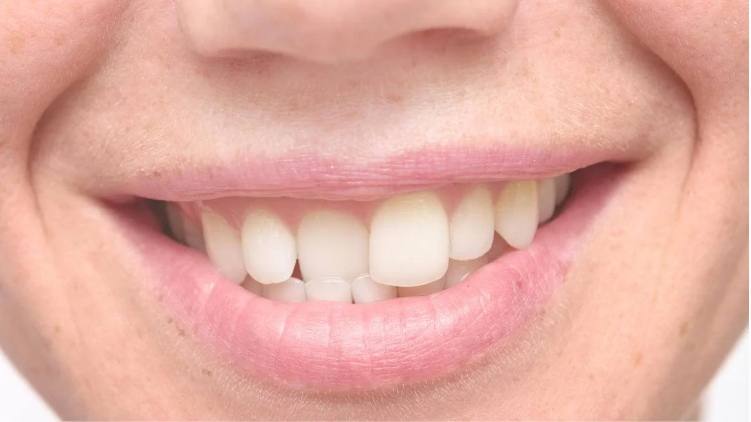 Diş Yamukluğu: Nedenleri Ve Oluşum Süreci