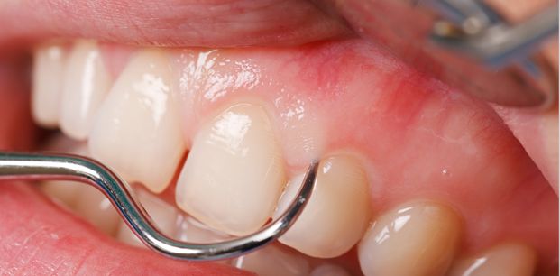 DİŞETİ (PERİODONTAL) HASTALIKLARI