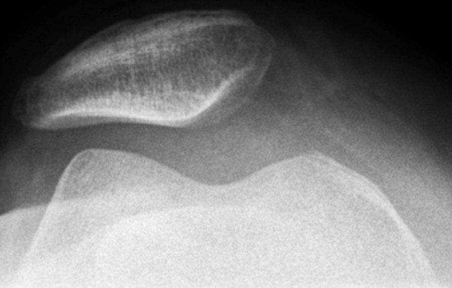 kniescheibenschmerzen-symptome-ursachen-und-therapie