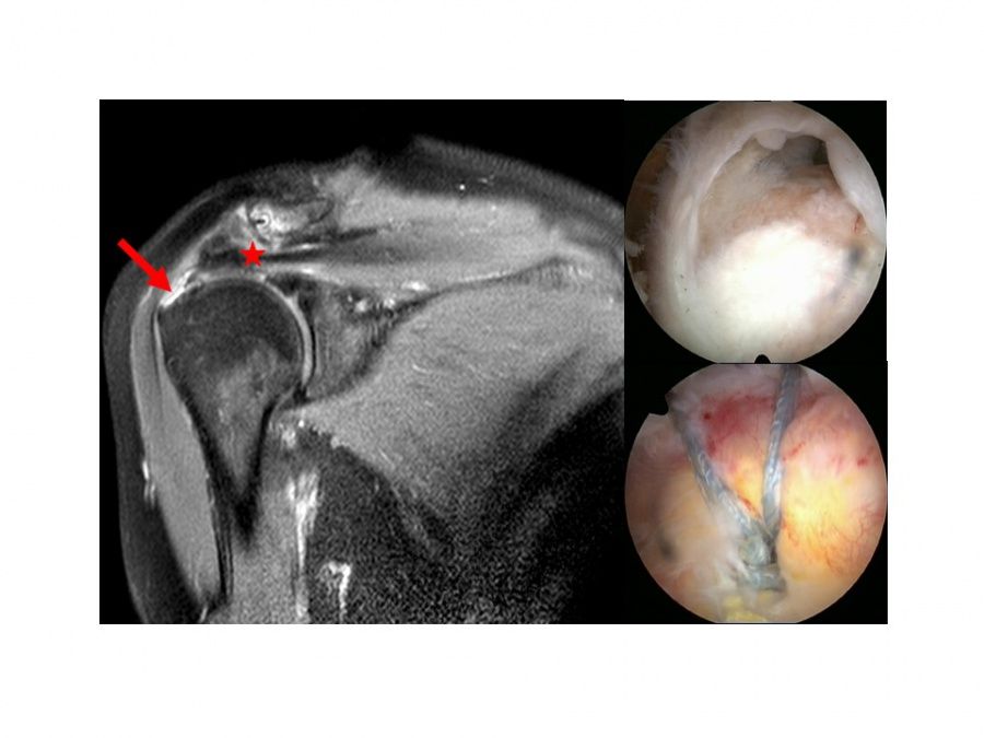 Rotatorenmanschettennaht und Schulterprothesen für Arthrose-Patienten