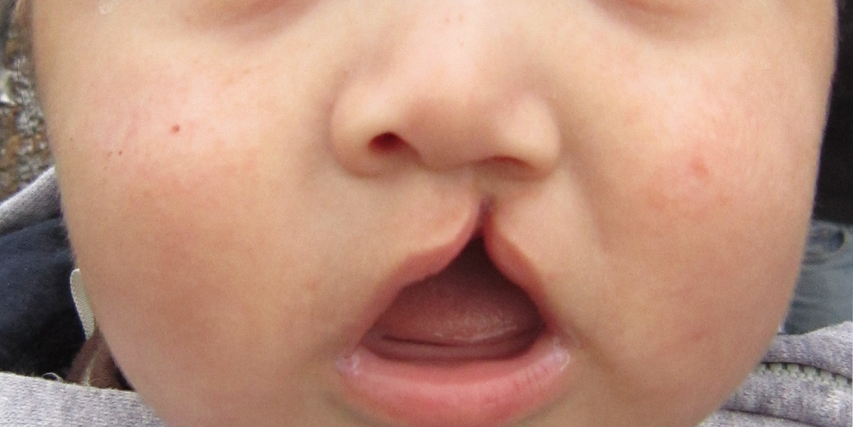 Dudak-Damak Yarıklığı