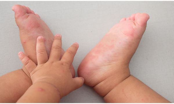 El-Ayak-Ağız Hastalığı 2