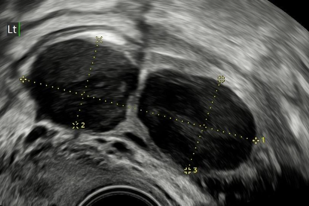 Ultrazvuk dvoukomorové endometriózní cysty vaječníku.