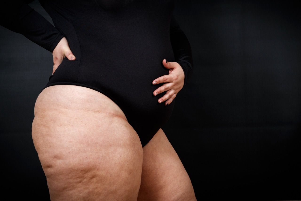 Drenaje linfático para lipedema: tratamiento y técnicas específicas
