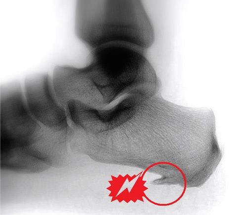 fersensporn-wenn-die-ferse-schmerzt