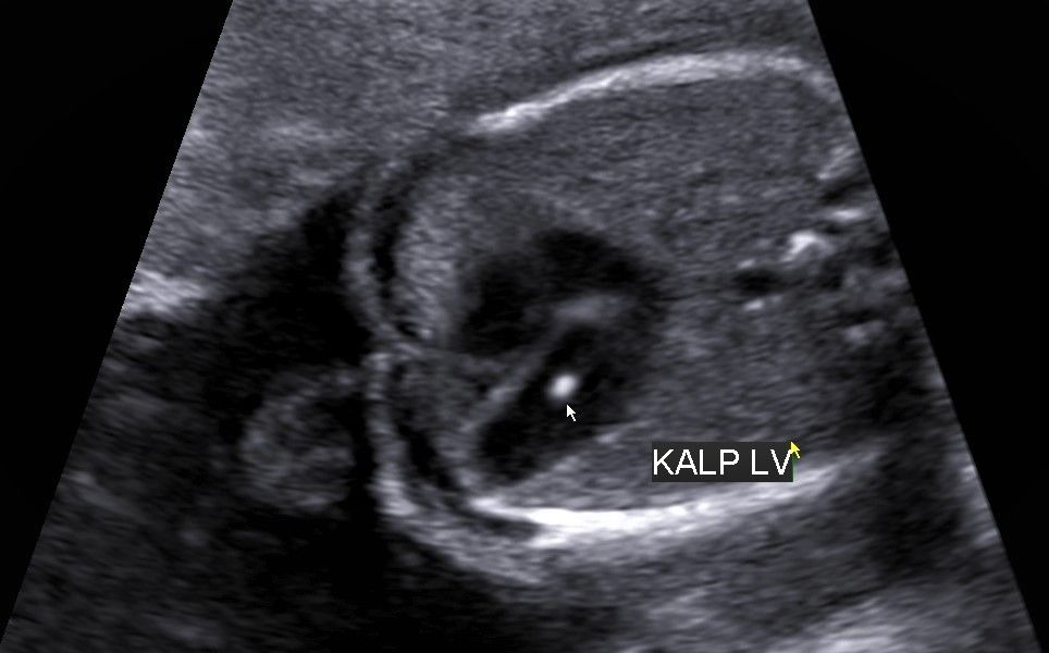 Fetal İntrakardiyak Ekojen Odak Nedir?