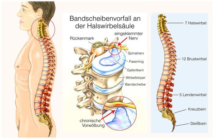 Bandscheibenvorfall mit Physiotherapie behandeln: 3 Therapien