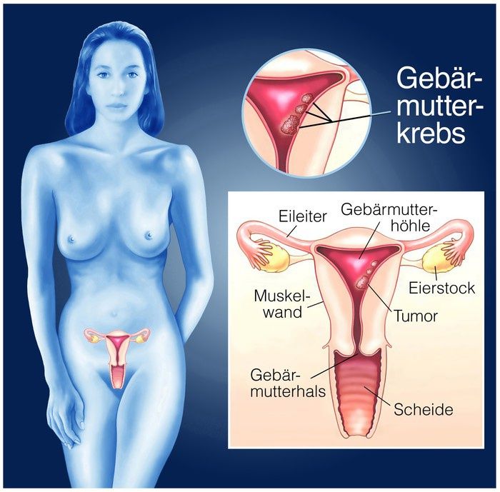 blutung-des-gebaermutterkoerpers-ein-krebssymptom