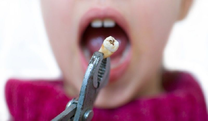 weisheitszahn-entfernung-danach-richtig-verhalten