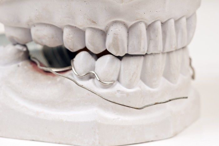 zahnersatz-fuer-backenzaehne-behandlungsmoeglichkeiten