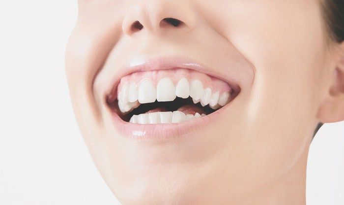 veneers-an-nur-einem-zahn-ablauf-der-behandlung