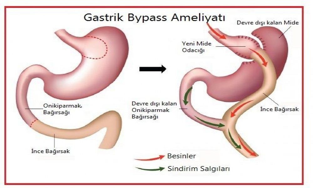 Gastrik Bypass Nedir?