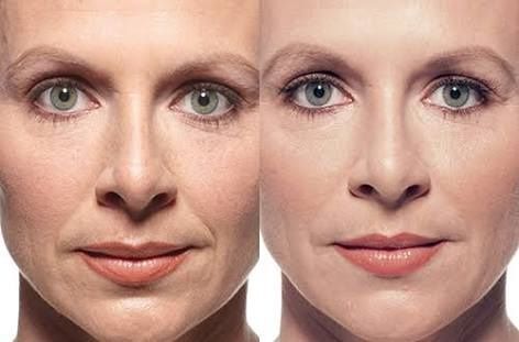 Göz Altı Işık Dolgusu 3