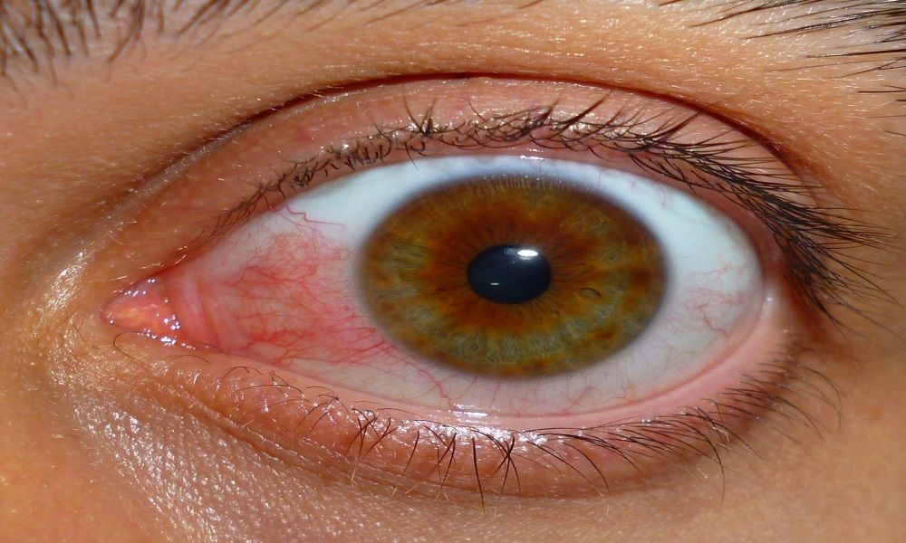 GÖZ İÇİ KANAMALARI