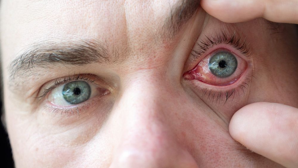 homem com conjuntivite