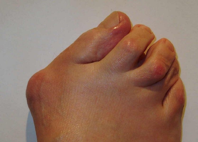 welche-op-methode-bei-hallux-valgus-hallux-operieren