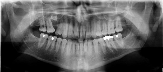 Hangi sıklıkla diş röntgenleri çektirmeliyim?