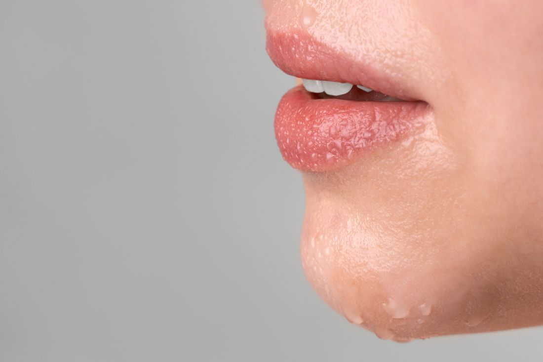 Qué es el herpes labial: causas, síntomas y tratamiento