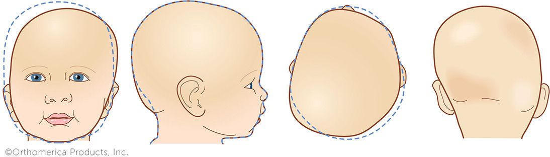Kafa Şekil Bozuklukları: Nedenleri, Belirtileri ve Tedavi Seçenekleri