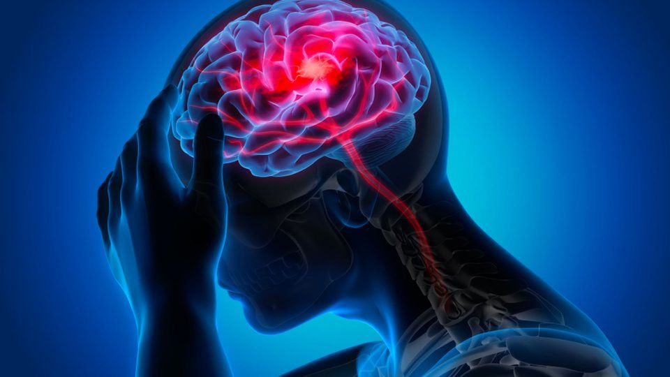 Kafa Travmaları ve Beyin Kanamaları: Riskler, Belirtiler ve Tedavi