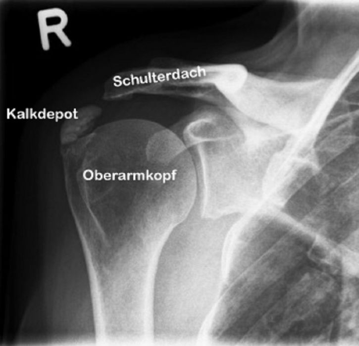 kalkschulter-symptome-therapie-und-arthroskopie