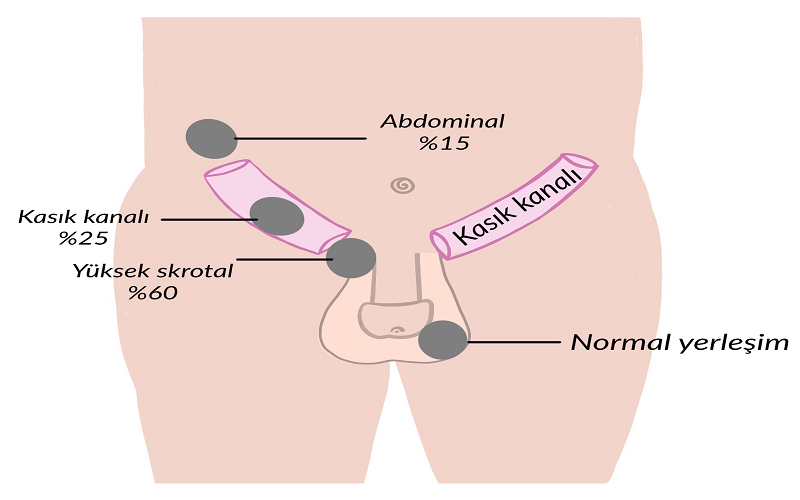 Kasık Fıtığı Nedir?