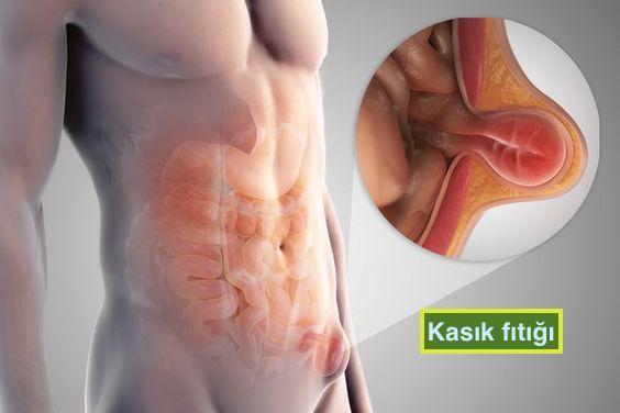 Kasık Fıtığı 7