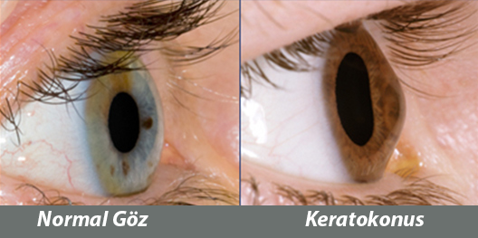 KERATOKONUS NEDİR?