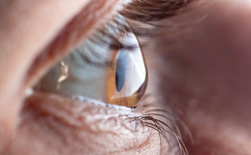 Keratokonus ve İlerlemesini Anlamak