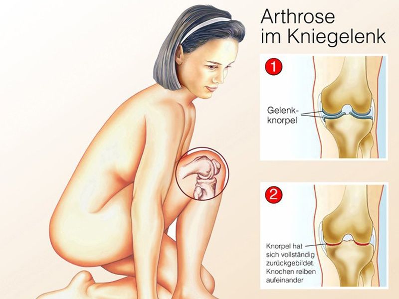 PSI – Der Kniegelenksersatz der Zukunft: Vorteile, Risiken & Ablauf