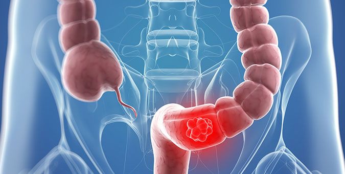 Kolon kanseri ve tarama yöntemleri