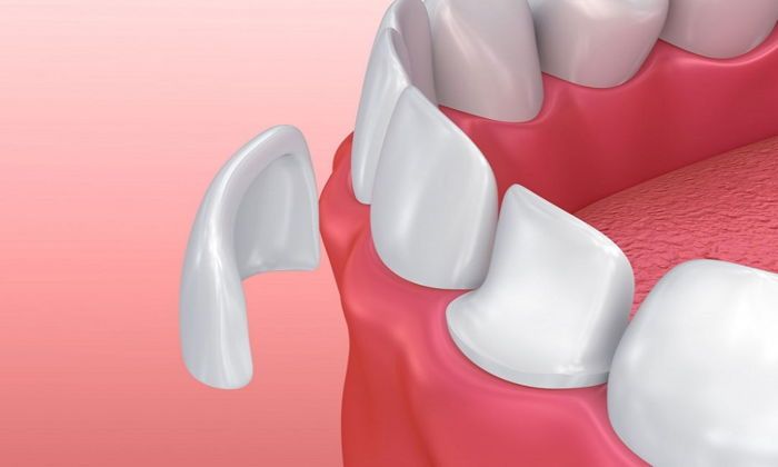 Kompozit Lamine Veneer Nedir? Nasıl Yapılır?