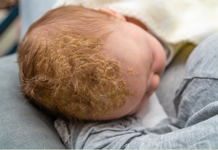 Konak (Seboreik Dermatit, Yağlı Egzama)