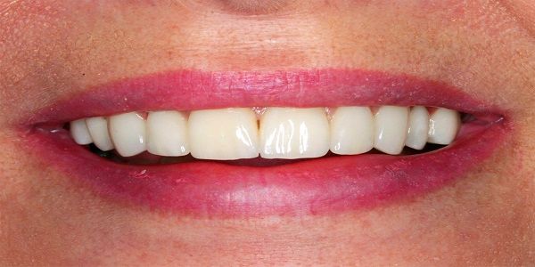 Küretaj Nedir Nasıl Yapılır?