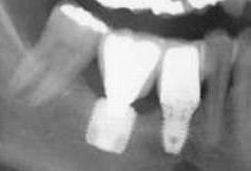 kurze-implantate-knochenaufbau-umgehen