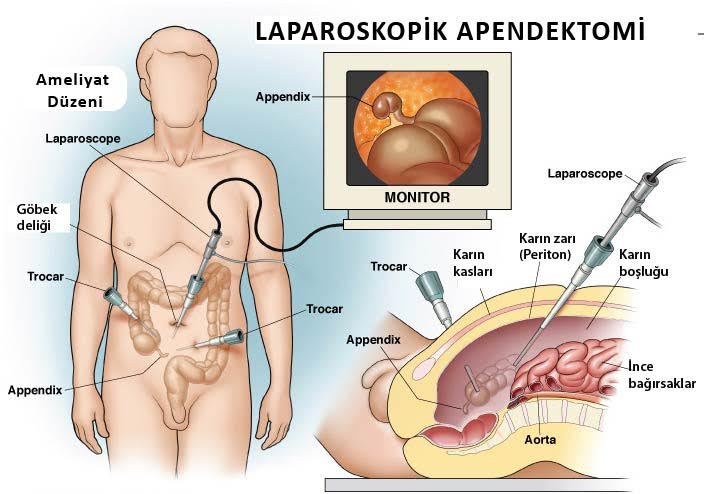 Laparoskopik Apendektomi