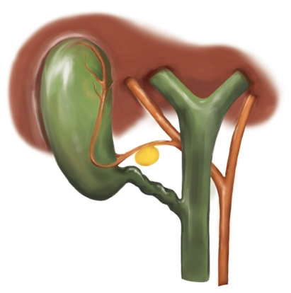 Laparoskopik Safra Kesesi Ameliyatı