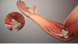 Lateral-Medial Epikondilit (Tenisçi-Golfçü Dirseği)